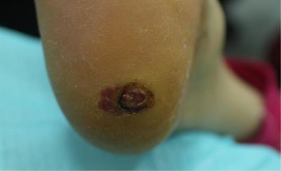 Case report: Type 2 diabetes mellitus with plantar malignant melanoma: Report of two cases